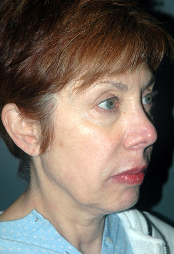 NON-SURGICAL FACE LIFT - Patient 3 - Before NON-SURGICAL FACE LIFT - Patient 3 - Before